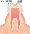 C1（エナメル質が虫歯に）