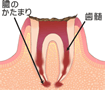 C4（歯根に達した虫歯）