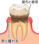 P2軽度歯肉炎
