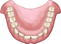 総入れ歯