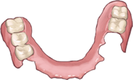 部分入れ歯